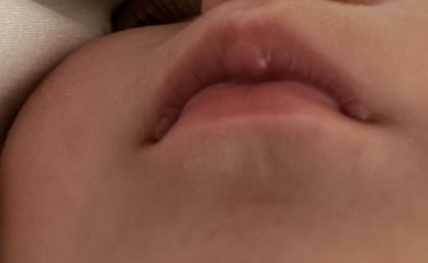 Suck blisters on 6 month olds lips