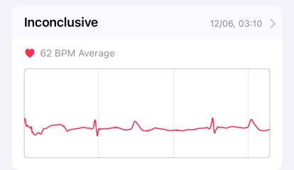 Can you advise on these ECG readings? Irregular thumping heart beats