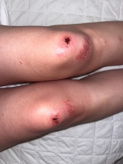 GROSS PHOTO WARNING - Frozen peas or A&E?
