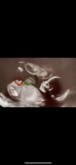 Have I ruined the gender surprise? :(