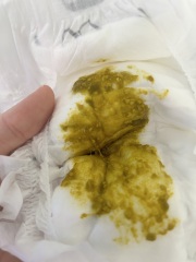 Is it dairy sensitivity?