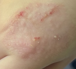 Is anyone a celiac with dermatitis herpetiformis? Photos attached