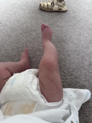 Clubbed foot? - questioning my own GP.