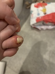 Broken toe, nail about to come off!