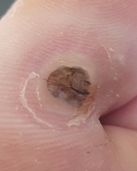 Is this a verruca still?? Picture attached