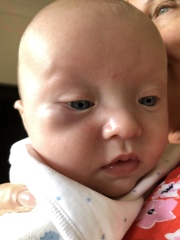 Swollen lump under eye