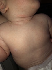 Cows milk allergy or heat rash?