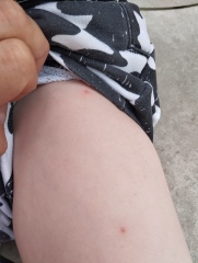 Chicken pox or something else?