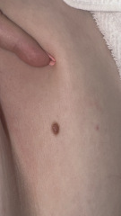New mole - normal ?