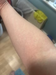 Scared woken up with this rash all over me