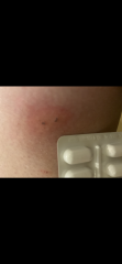 Could this be a tick bite?