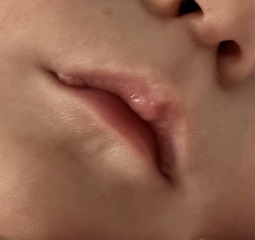 Suck blisters on 6 month olds lips