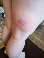 Horse fly bites? Photo