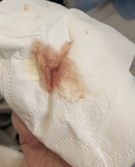 TW BLOOD PIC - advice!!