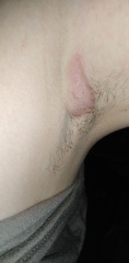 Underarm cyst/boil