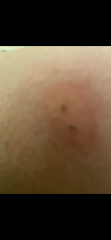 Could this be a tick bite?
