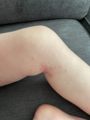 Chickenpox or HFMD? Pic included