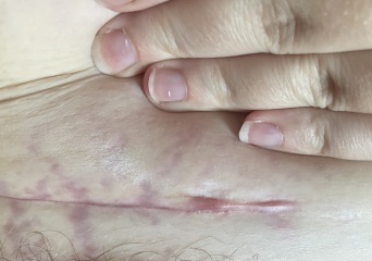 C section infection not clearing after 4 rounds of antibiotics!