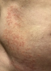 AIBU to ask what this rash on the torso is? Photos