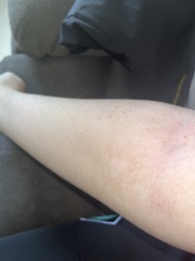 Brown stuff on skin