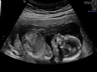 Is this a boy or girl scan? 