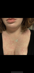 Allergy specialist in Birmingham? And Anyone used Xolair injections?
