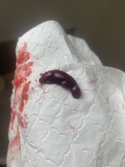 Miscarriage or period clot