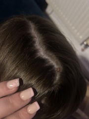 Concerned of skin mark?