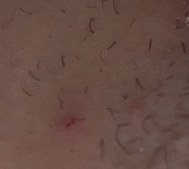 Yeast infection or herpes?
