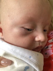 Swollen lump under eye