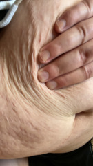 loose skin (help)