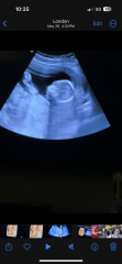 Low laying placenta???