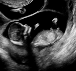Nub or skull theory, boy or girl (twins)?!