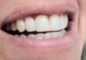 Invisalign - how much did yours cost and was it worth it?