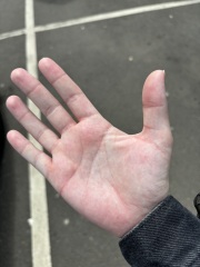 blotchy rash on palm of hands/soles of feet