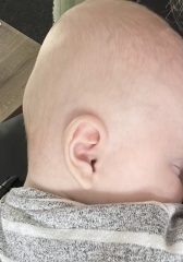 Plagiocephaly - HELP
