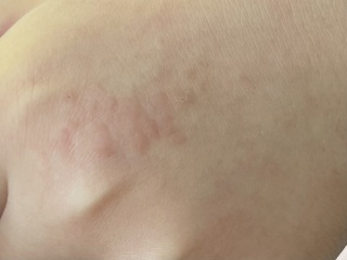 Is anyone a celiac with dermatitis herpetiformis? Photos attached