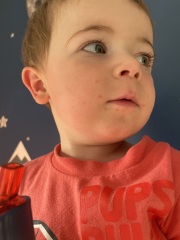 HFMD or chickenpox?