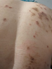What is this on my sister’s back? Pic included