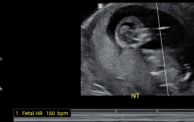 12 week scan - nub/ skull theory 
