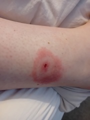 Bite