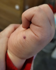 Rash on toddler
