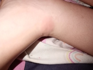 Circular rash
