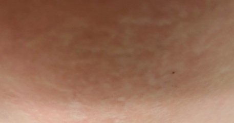 Scared woken up with this rash all over me