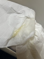 **photo** discharge or mucus plug?