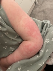 Weird rash?