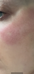 Eczema/Allergies/Diet/HRT/getting older ?