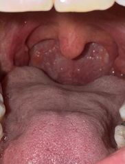 Sore throat on one side