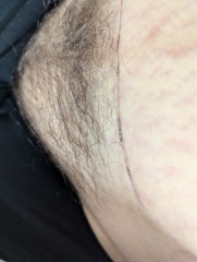 C-section incision has lumpy bits sticking out?