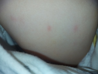 Could this be chicken pox
